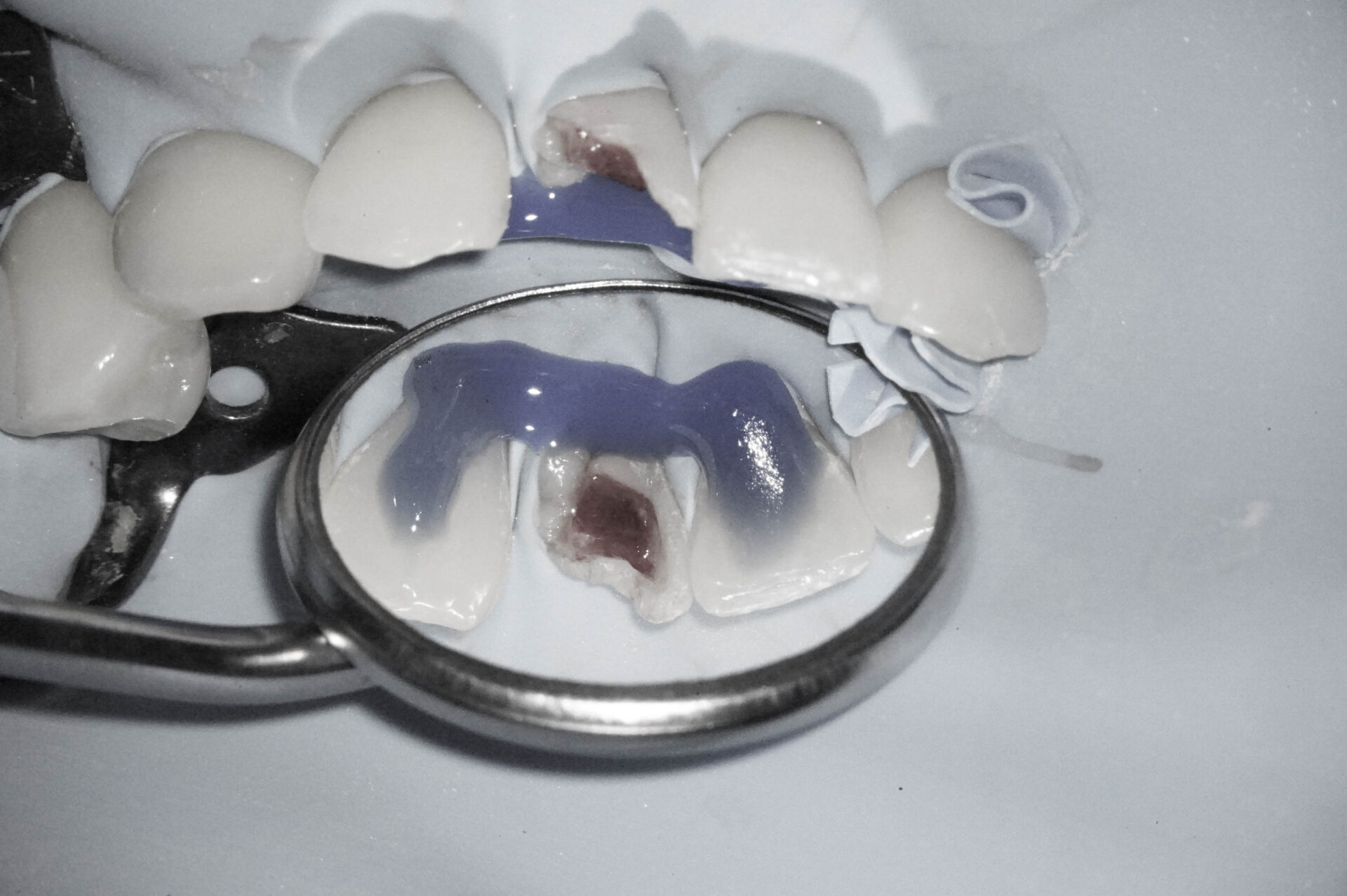 事故で歯が折れてしまった学生の方の治療（歯髄温存療法　MTAセメント）治療方法02