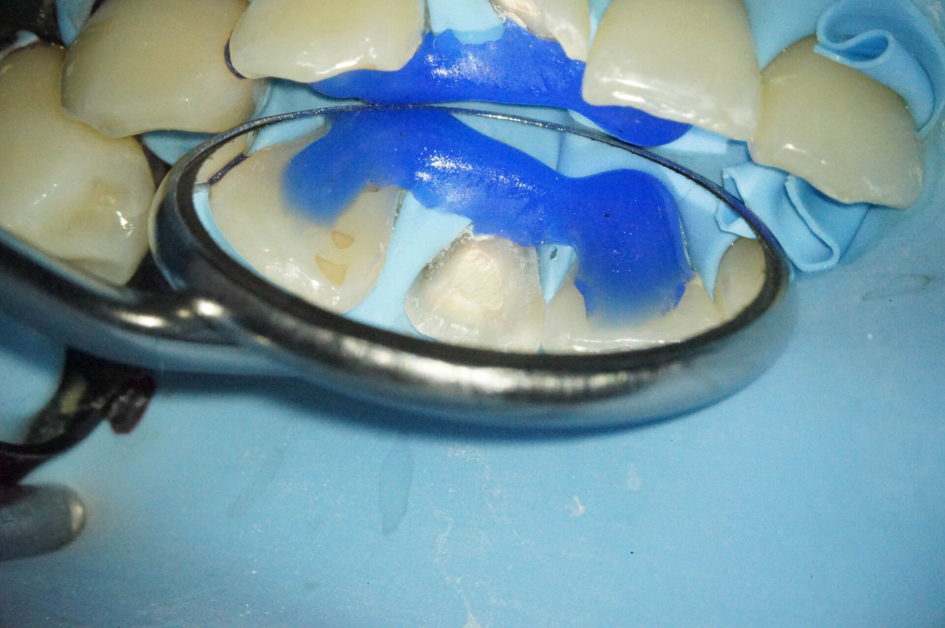 事故で歯が折れてしまった学生の方の治療（歯髄温存療法　MTAセメント）治療方法03