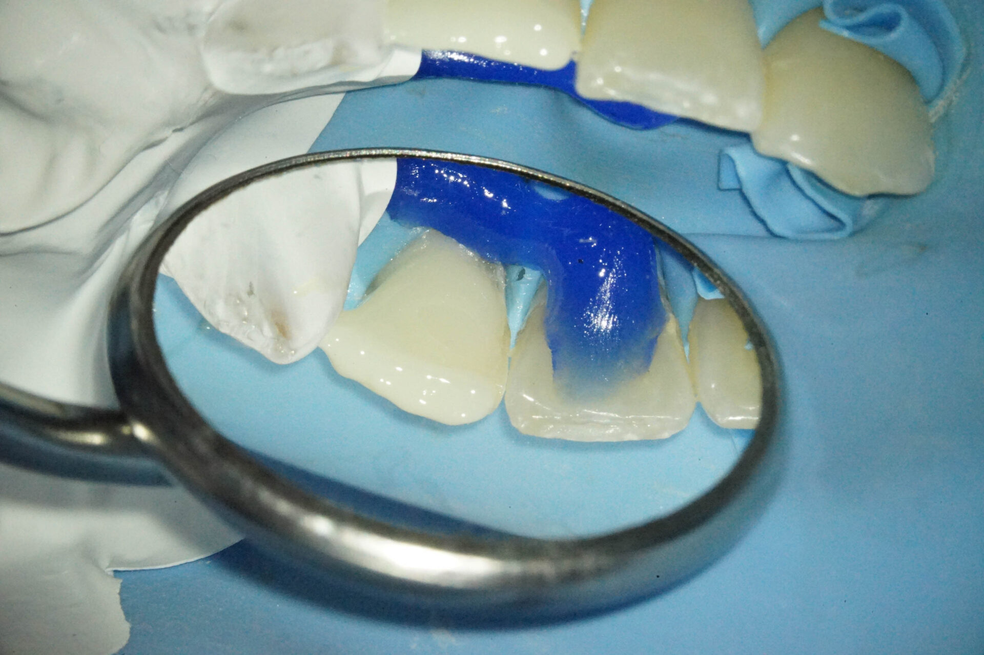 事故で歯が折れてしまった学生の方の治療（歯髄温存療法　MTAセメント）治療方法04