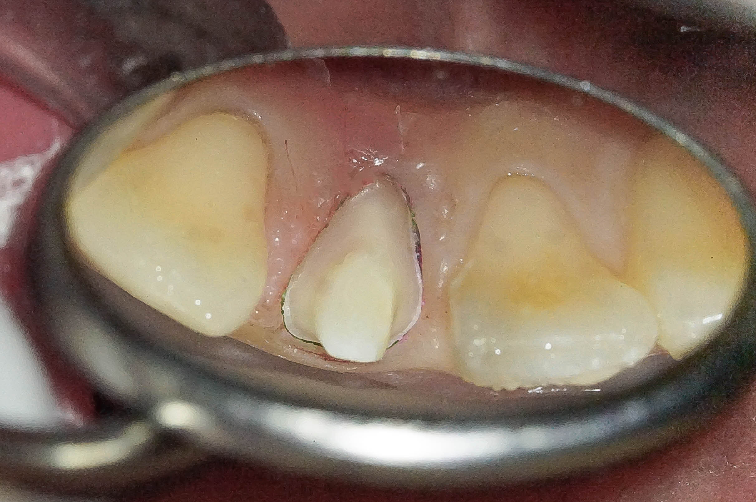 事故で歯が折れてしまった学生の方の治療（歯髄温存療法　MTAセメント）治療方法06