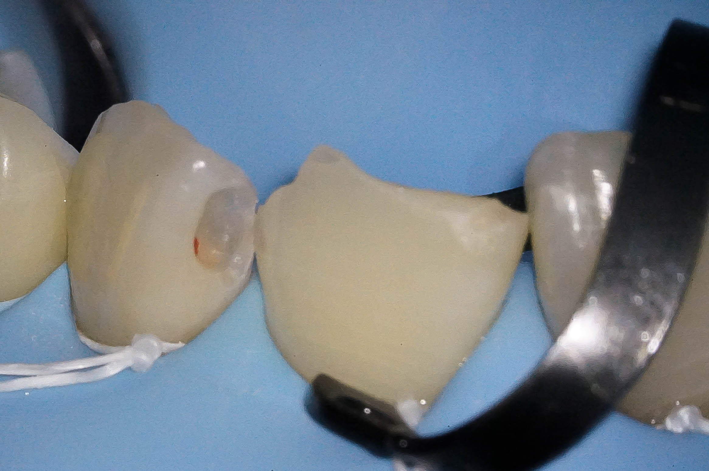 事故で歯が折れてしまった学生の方の治療（歯髄温存療法　MTAセメント）治療方法10