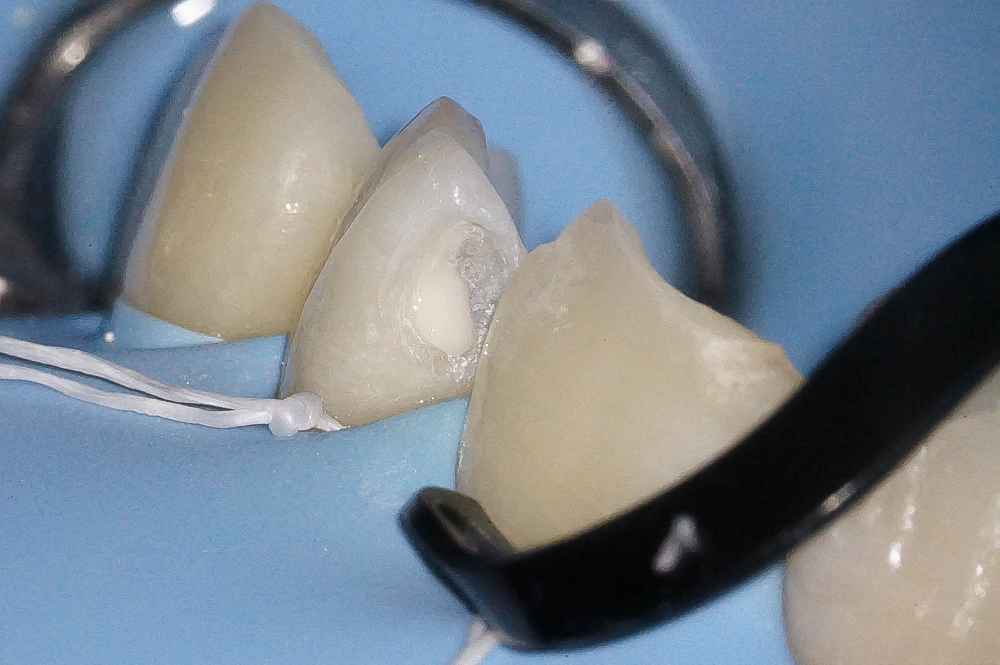 事故で歯が折れてしまった学生の方の治療（歯髄温存療法　MTAセメント）治療方法11