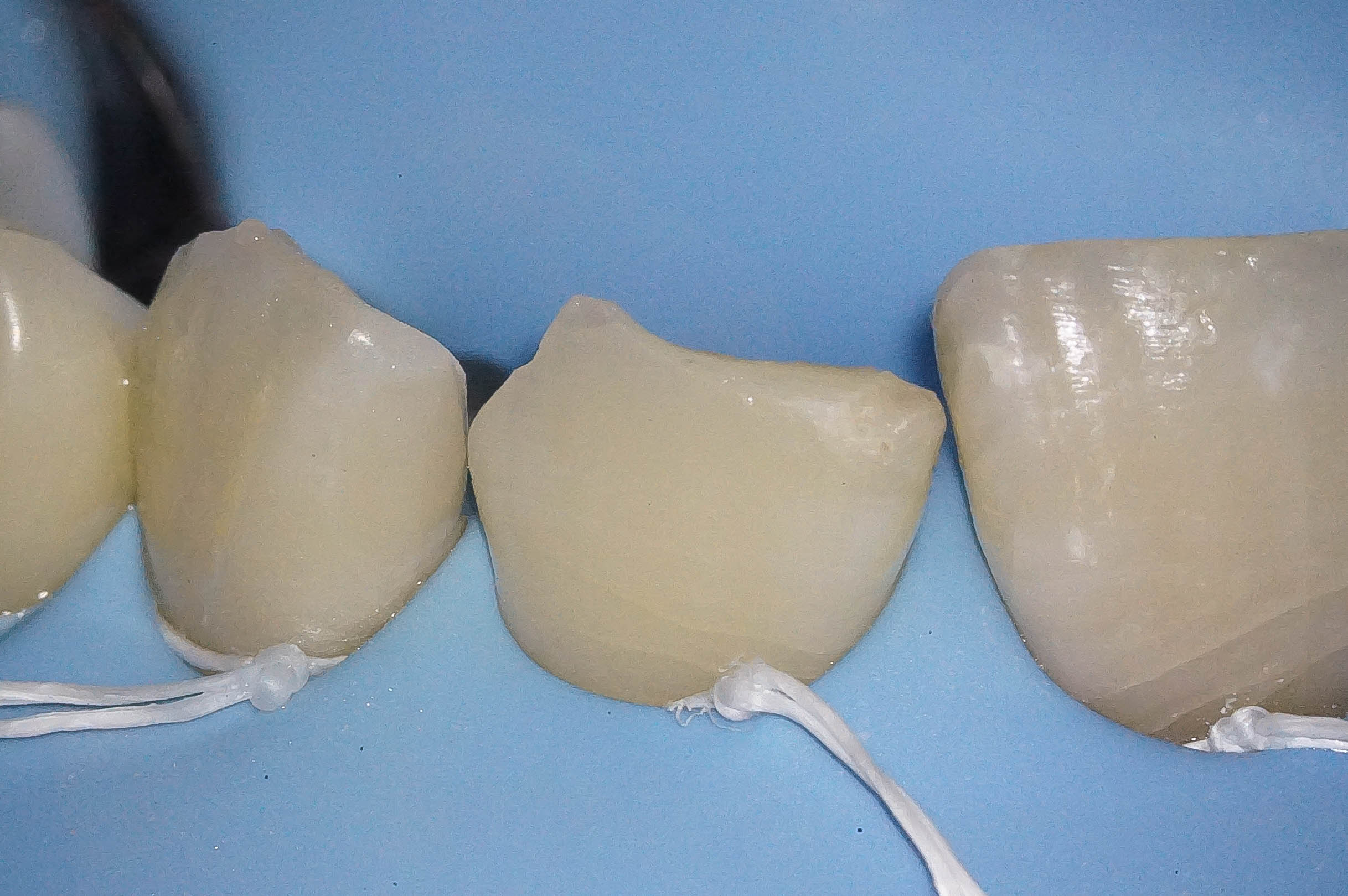 事故で歯が折れてしまった学生の方の治療（歯髄温存療法　MTAセメント）治療方法13
