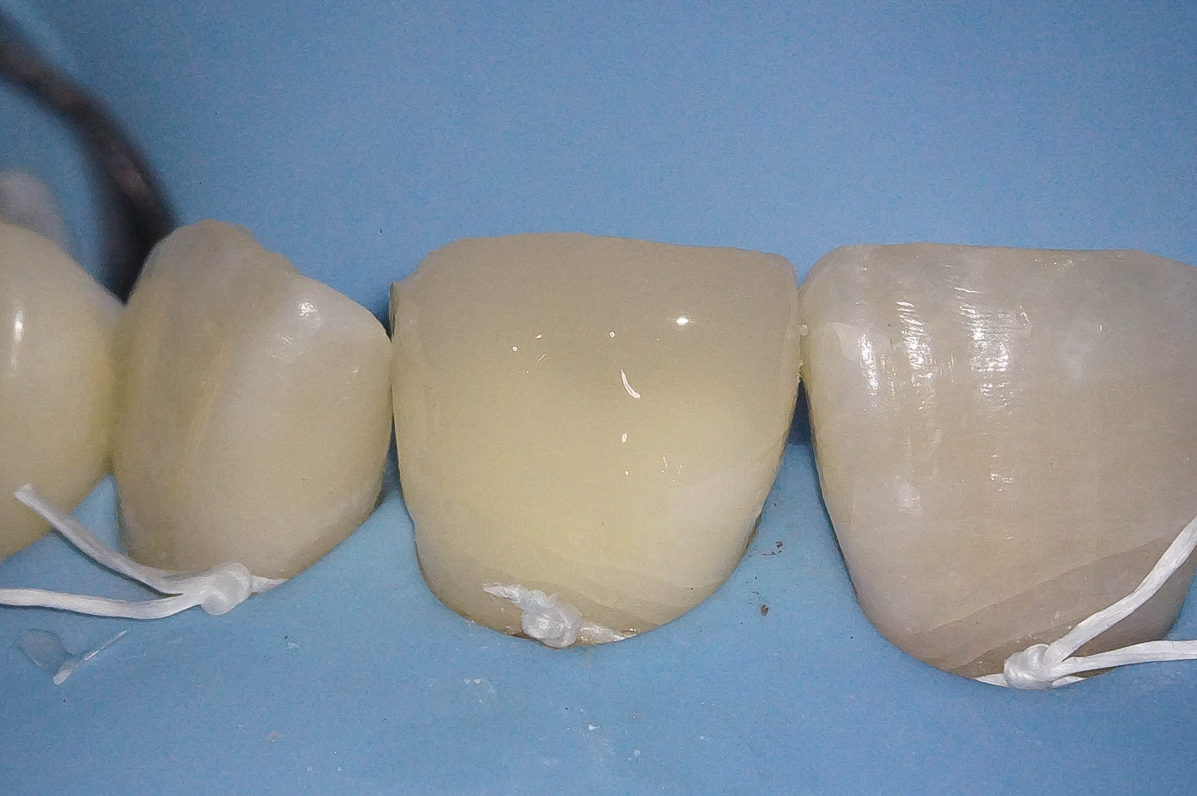 事故で歯が折れてしまった学生の方の治療（歯髄温存療法　MTAセメント）治療方法14
