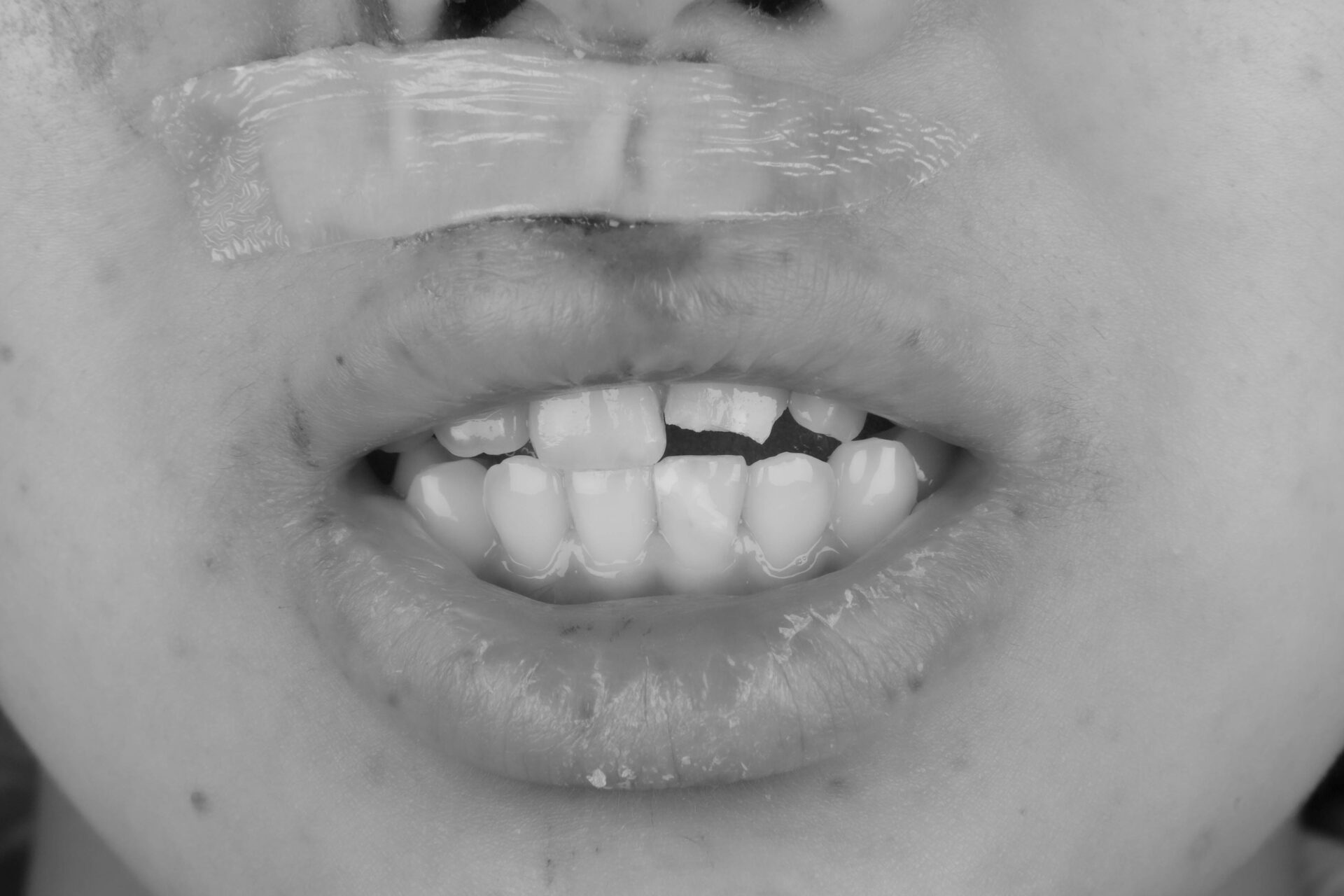 事故で歯が折れてしまった学生の方の治療（歯髄温存療法　MTAセメント）治療方法01