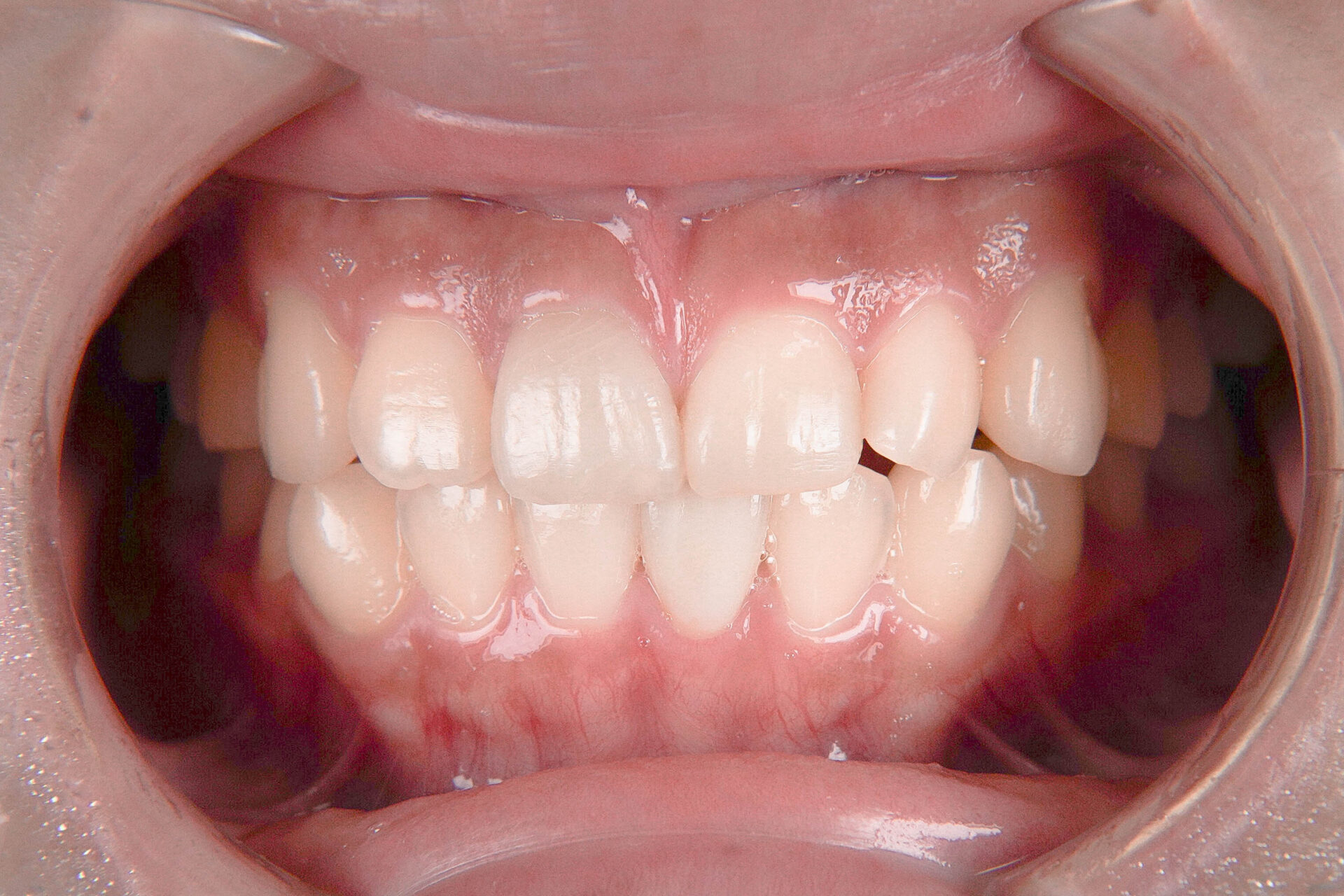 事故で歯が折れてしまった学生の方の治療（歯髄温存療法　MTAセメント）治療方法15