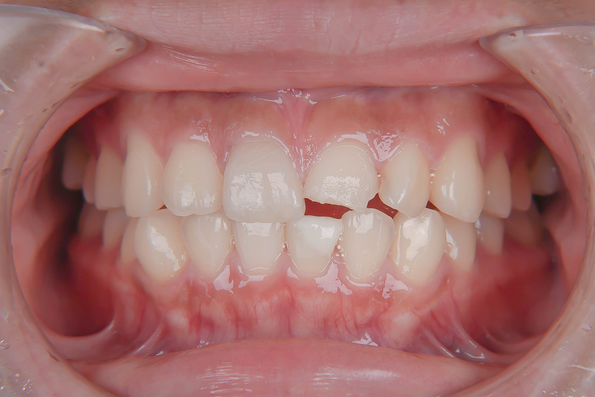 事故で歯が折れてしまった学生の方の治療（歯髄温存療法　MTAセメント）治療方法05