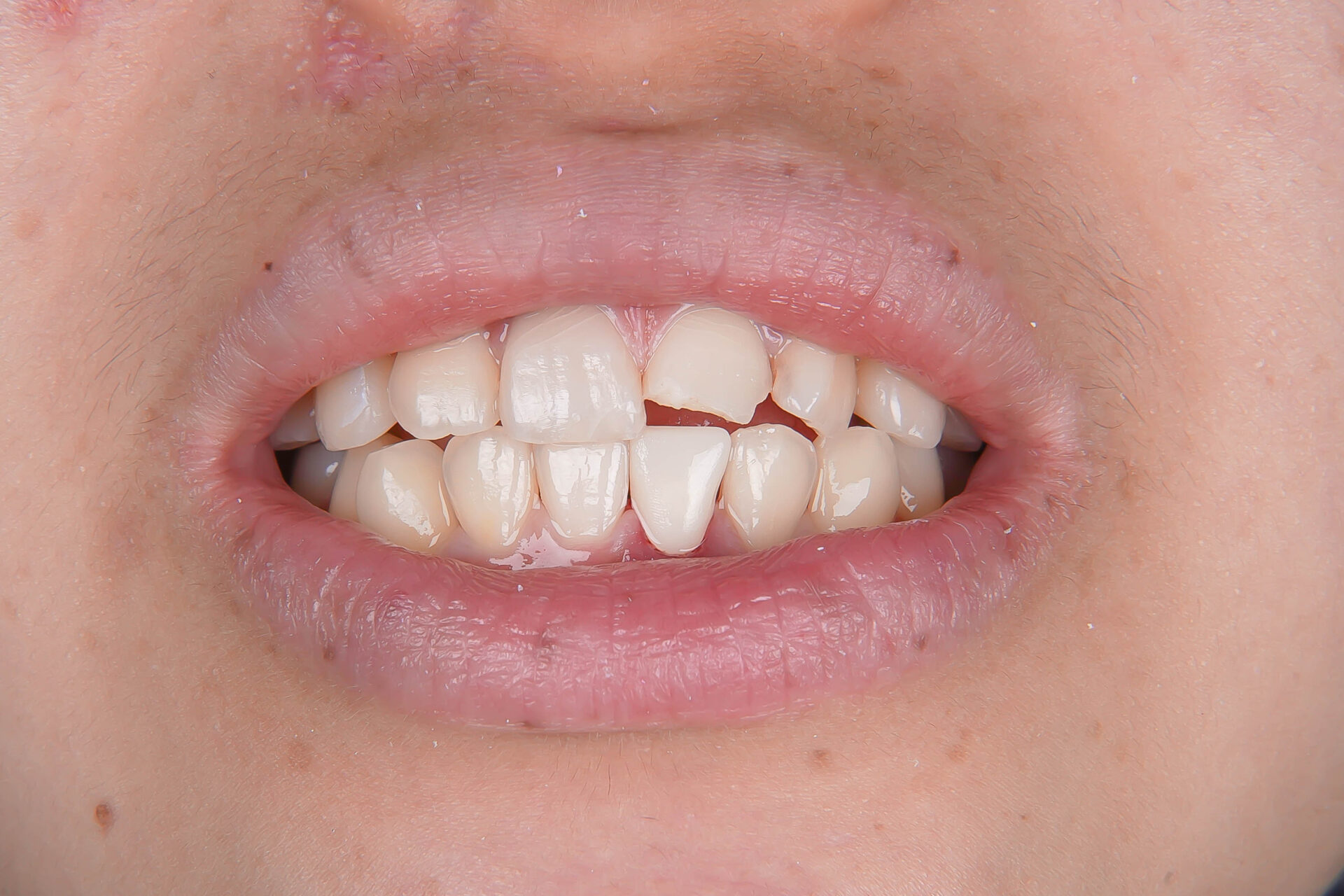 事故で歯が折れてしまった学生の方の治療（歯髄温存療法　MTAセメント）治療方法08