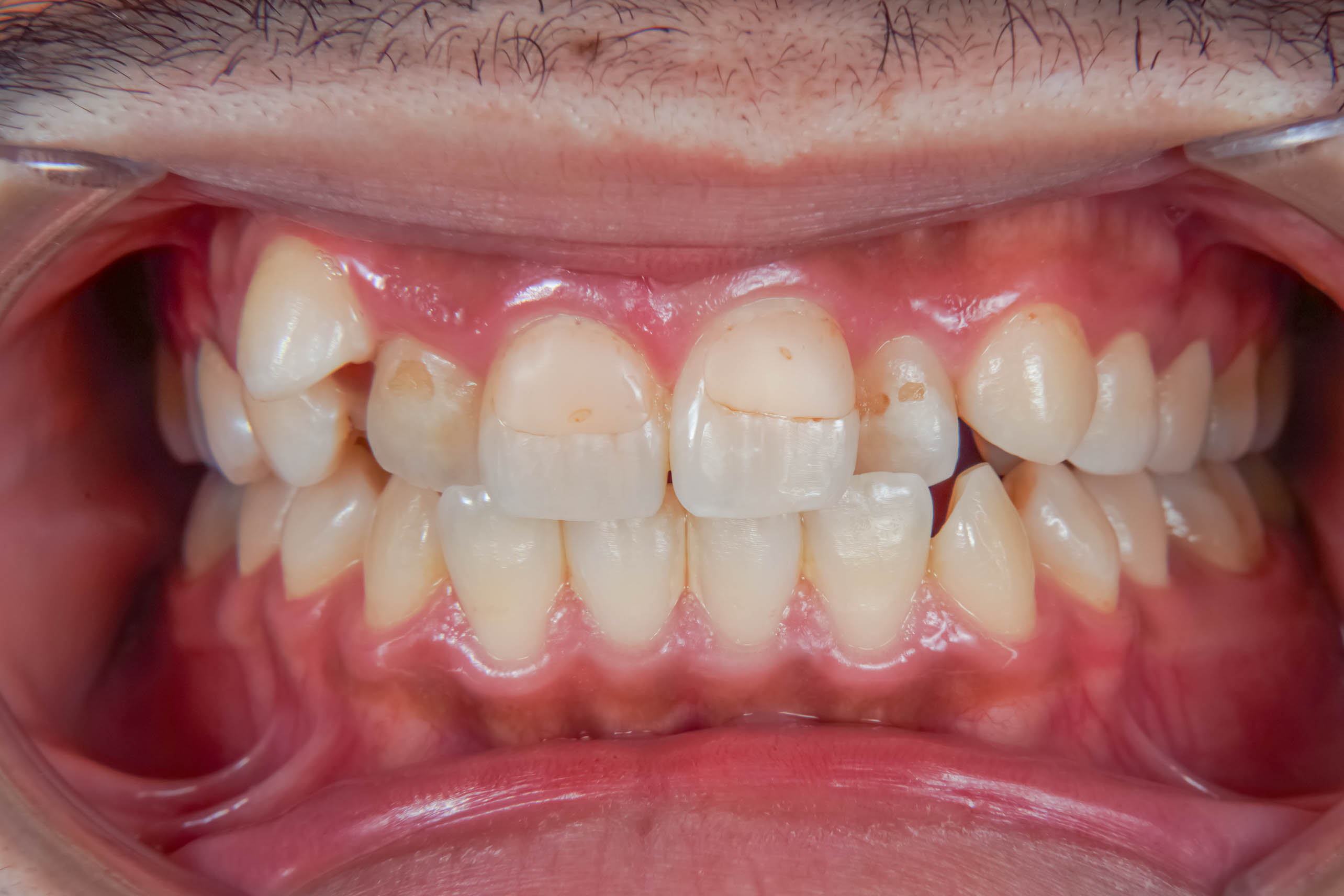 前歯の詰め物が茶色に汚れているケースの修復BEFORE