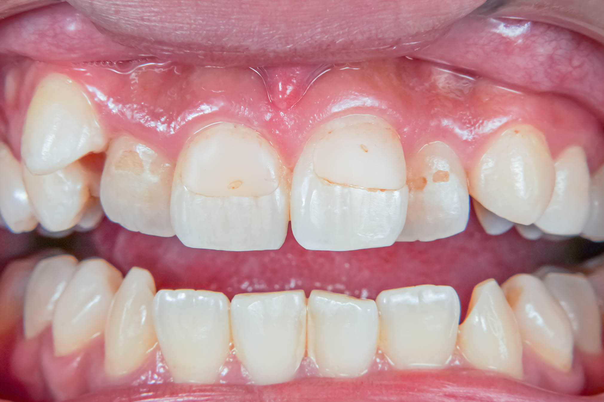 前歯の詰め物が茶色に汚れているケースの修復治療方法12