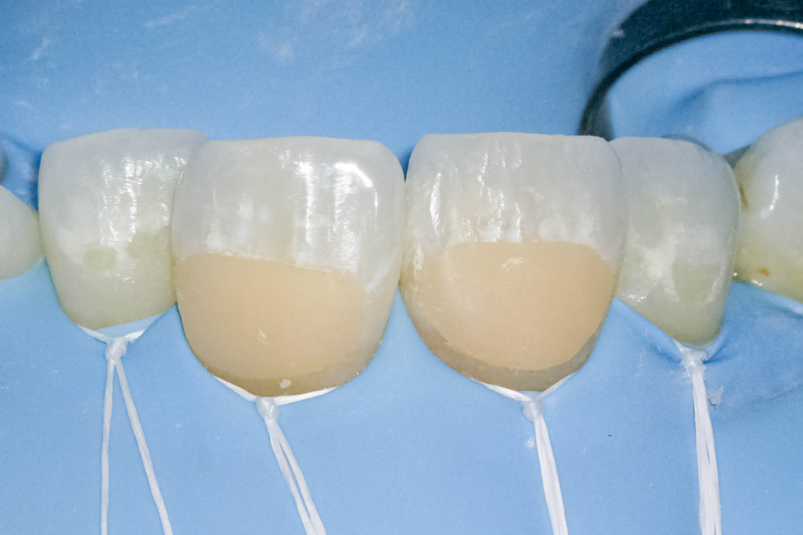 前歯の詰め物が茶色に汚れているケースの修復治療方法01