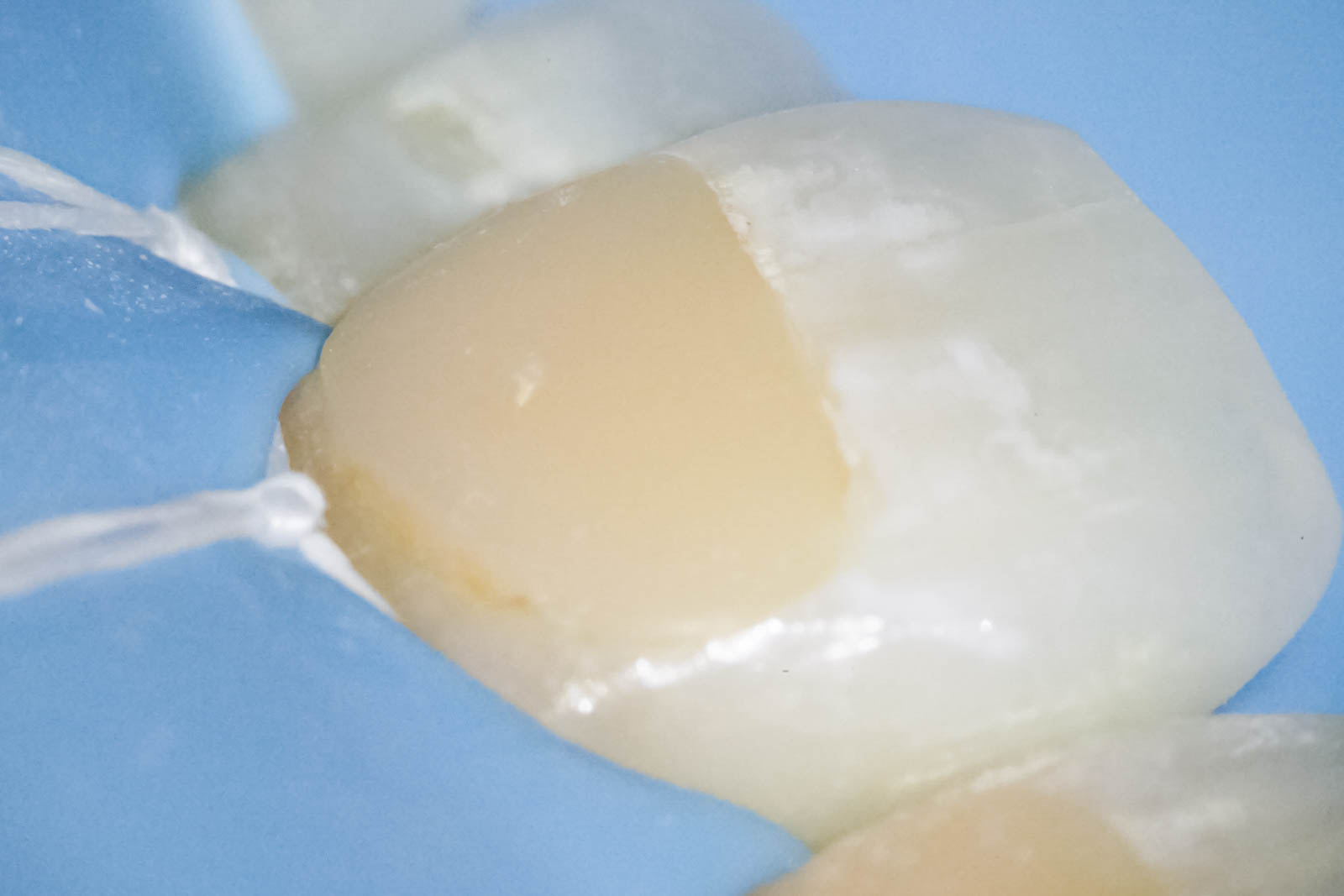 前歯の詰め物が茶色に汚れているケースの修復治療方法02