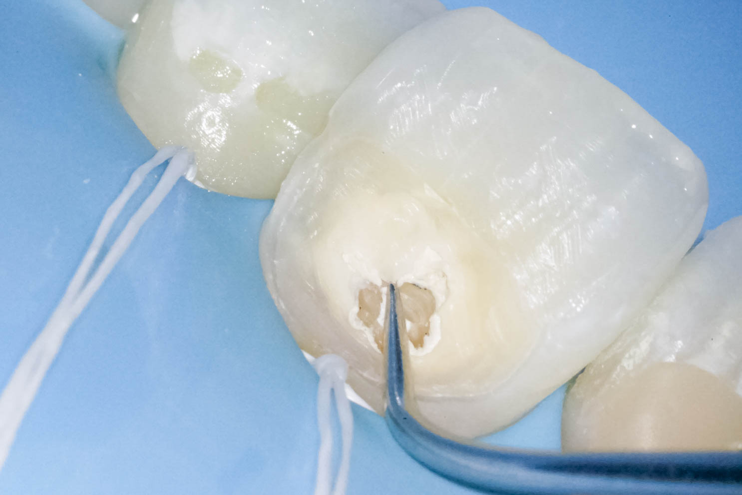 前歯の詰め物が茶色に汚れているケースの修復治療方法03