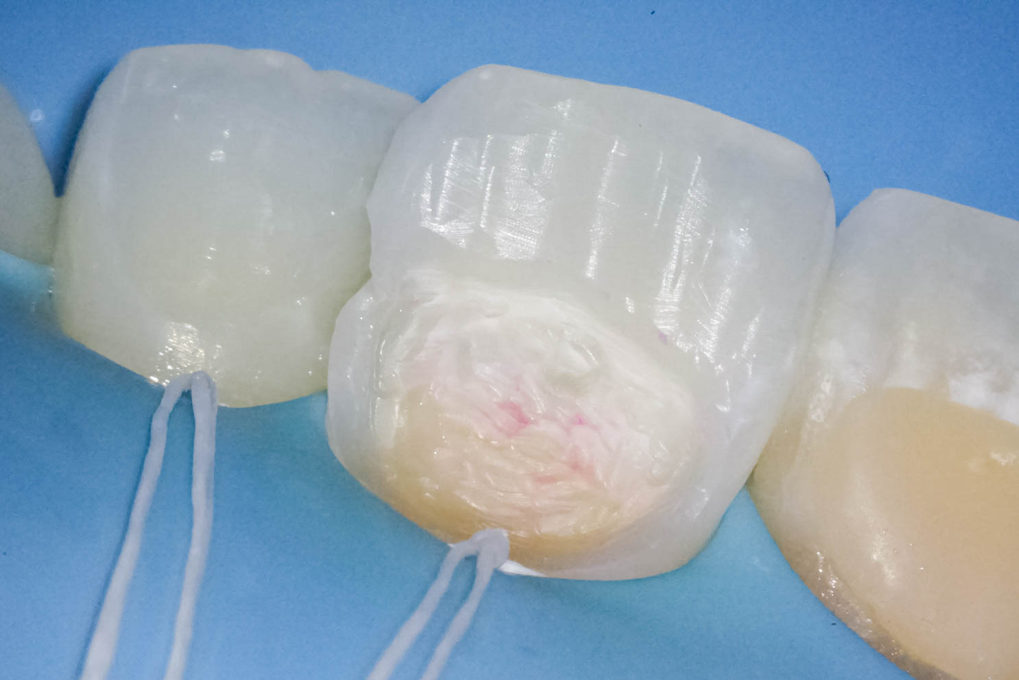 前歯の詰め物が茶色に汚れているケースの修復治療方法04