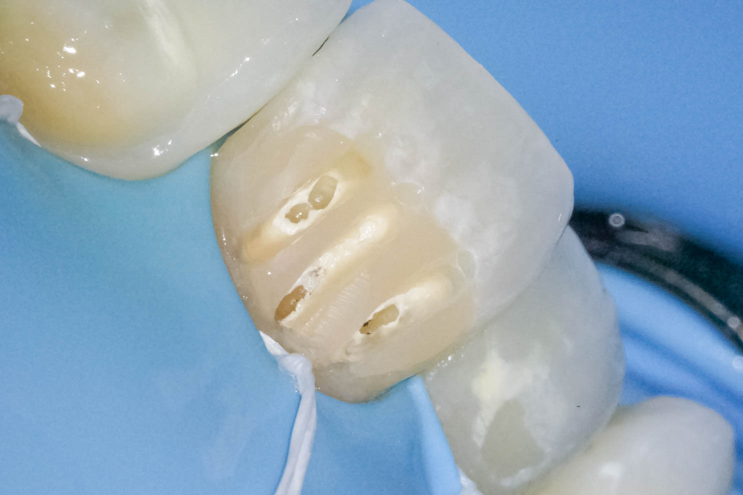 前歯の詰め物が茶色に汚れているケースの修復治療方法05