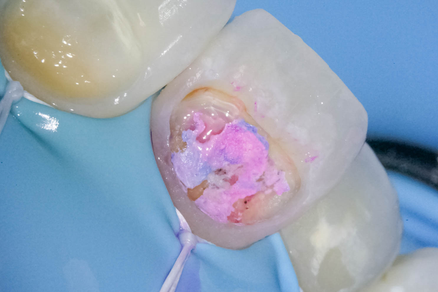 前歯の詰め物が茶色に汚れているケースの修復治療方法06