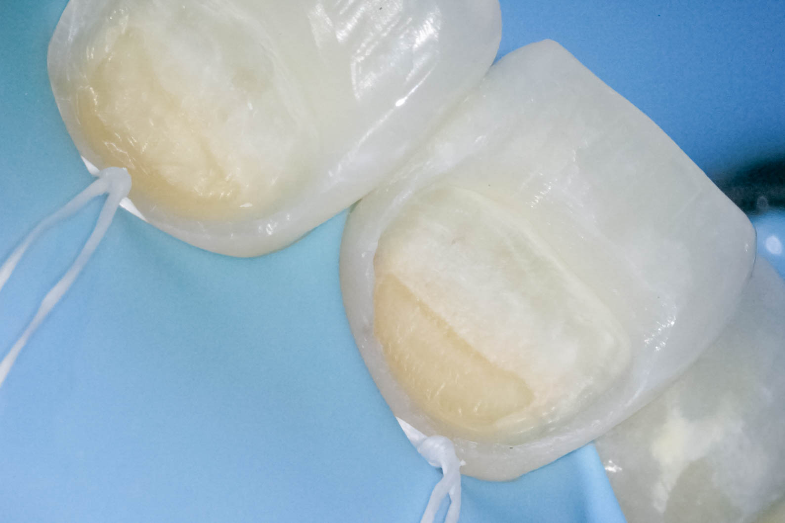 前歯の詰め物が茶色に汚れているケースの修復治療方法07