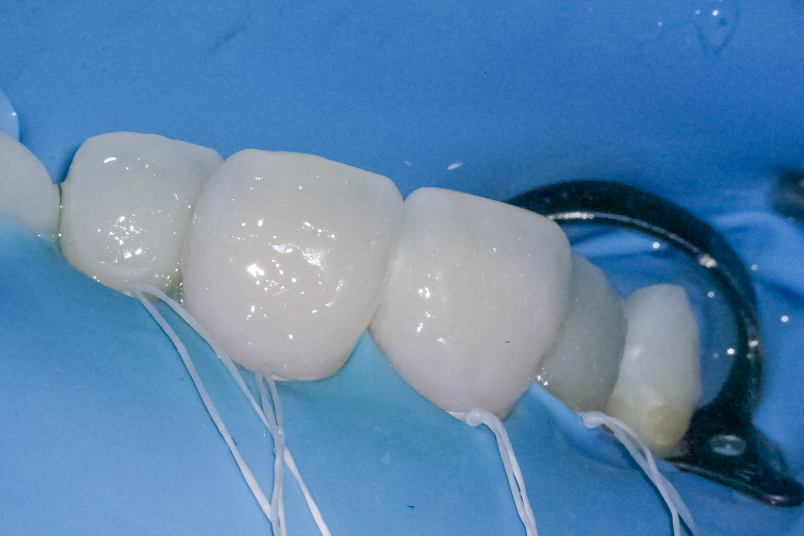 前歯の詰め物が茶色に汚れているケースの修復治療方法08