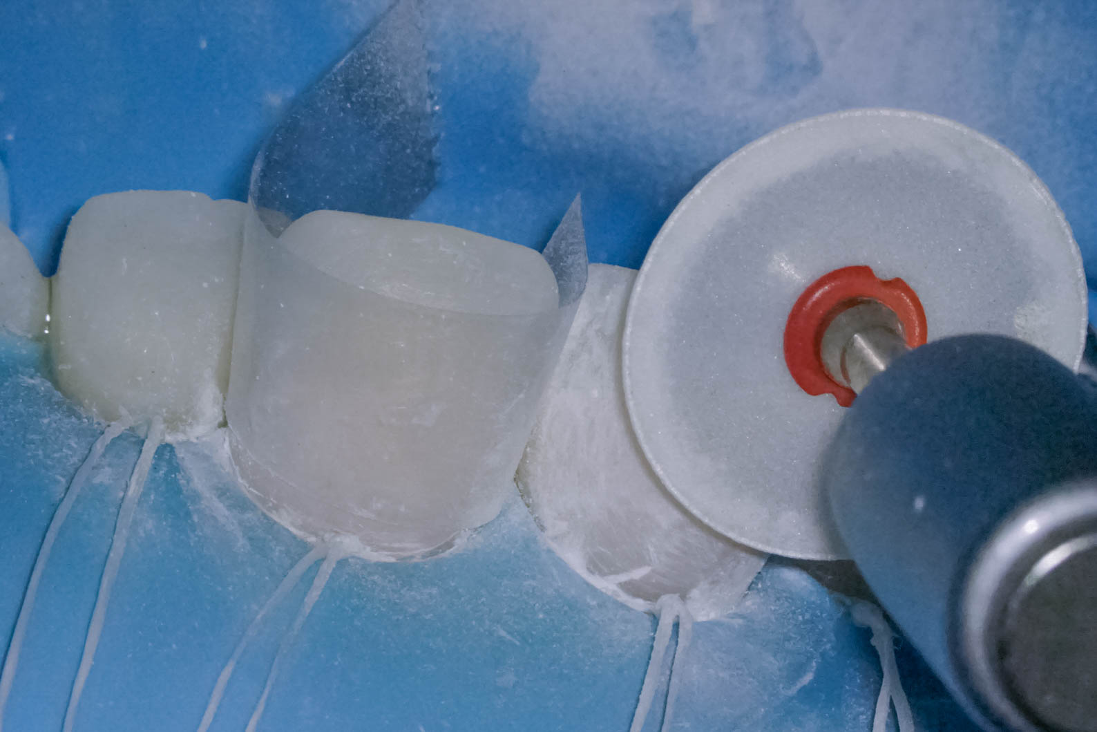 前歯の詰め物が茶色に汚れているケースの修復治療方法09