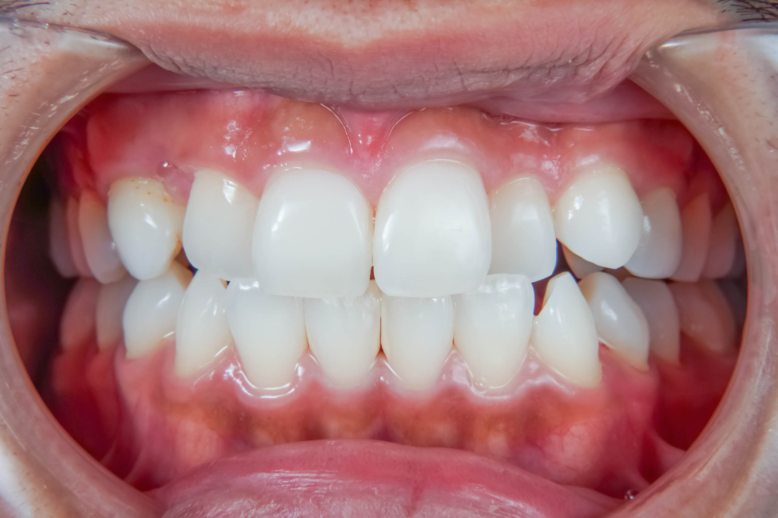前歯の詰め物が茶色に汚れているケースの修復BEFORE