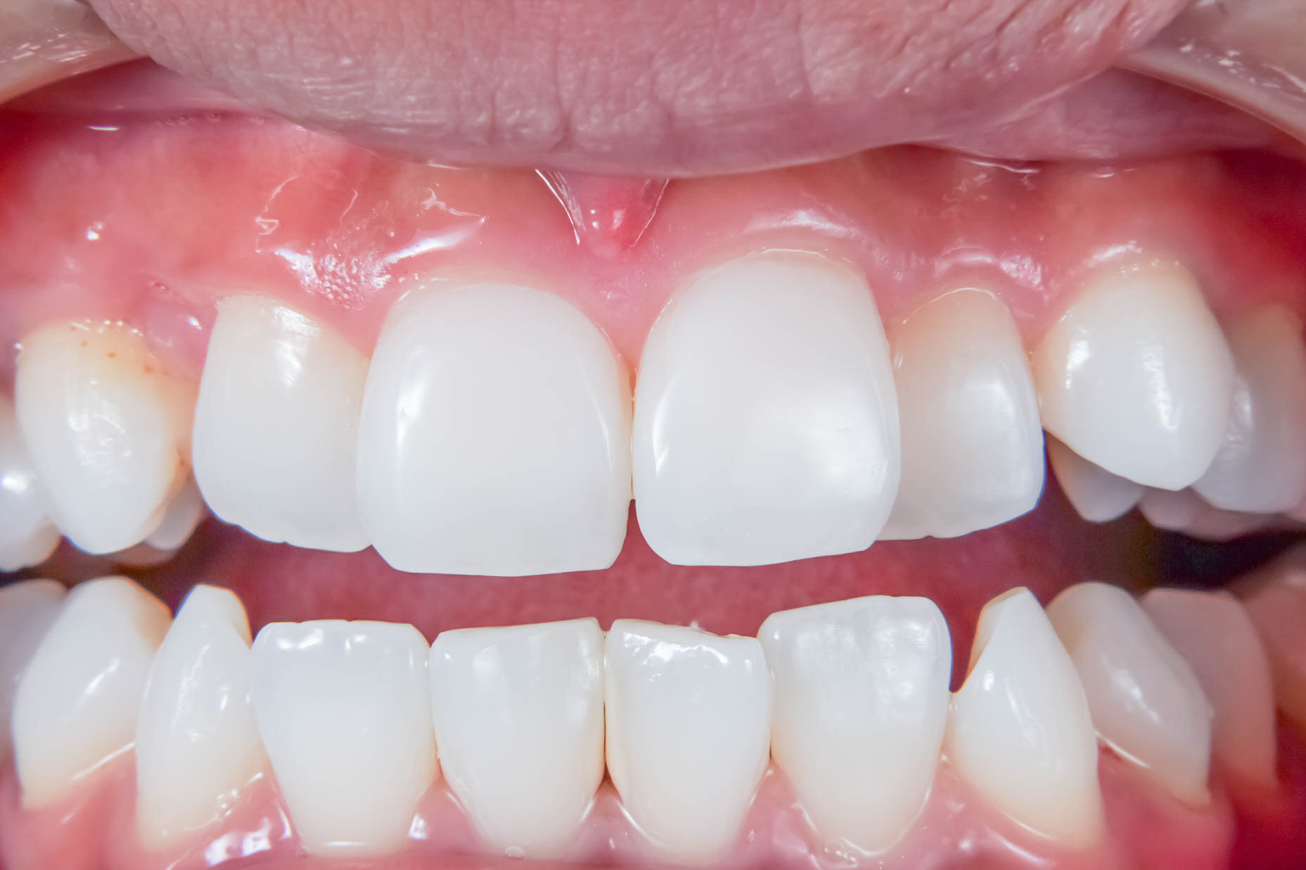 前歯の詰め物が茶色に汚れているケースの修復治療方法13