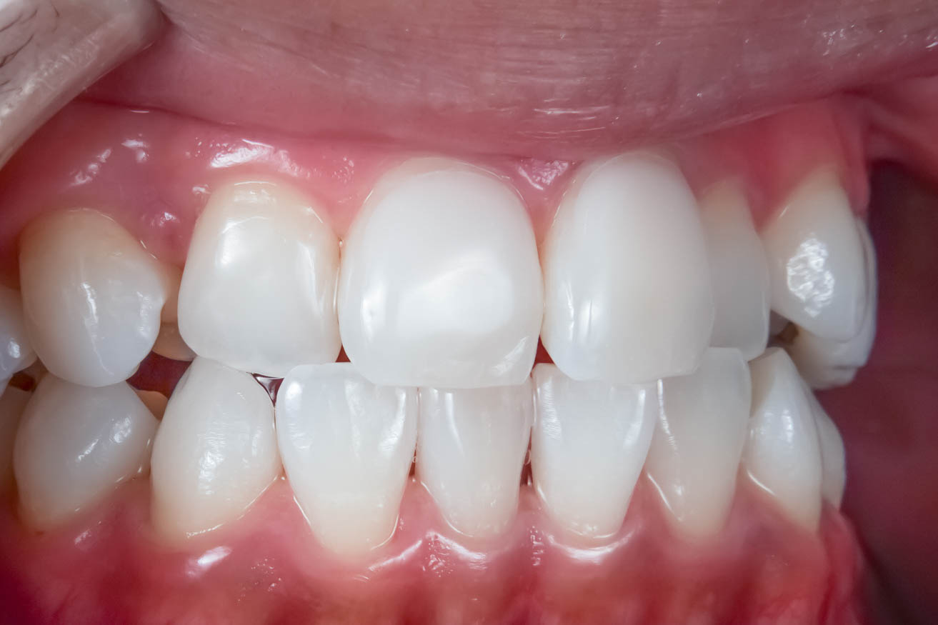 前歯の詰め物が茶色に汚れているケースの修復治療方法14