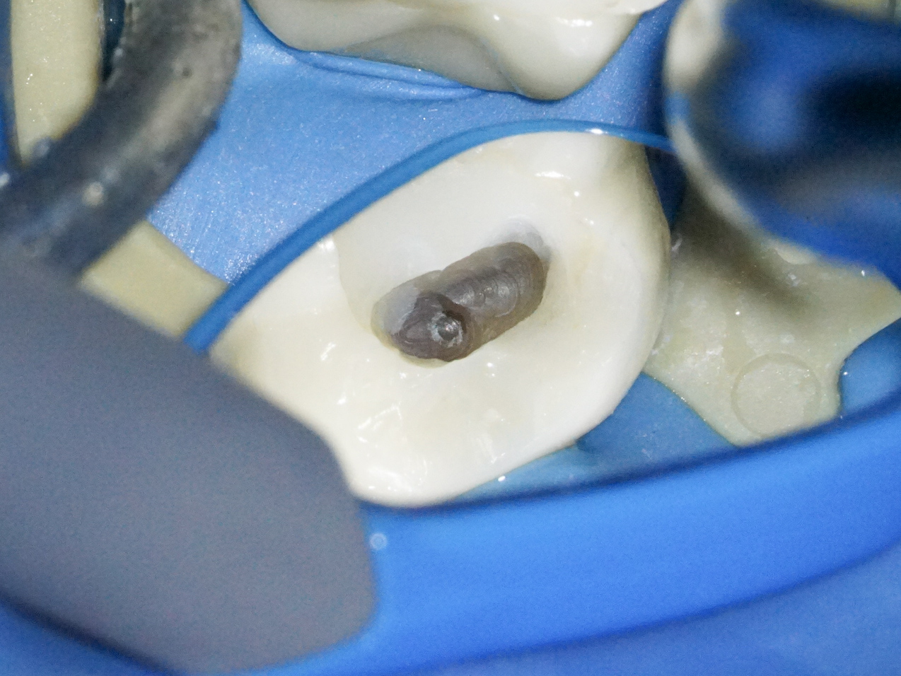 精密根管治療にて抜歯宣告された歯を救った症例　1治療方法03