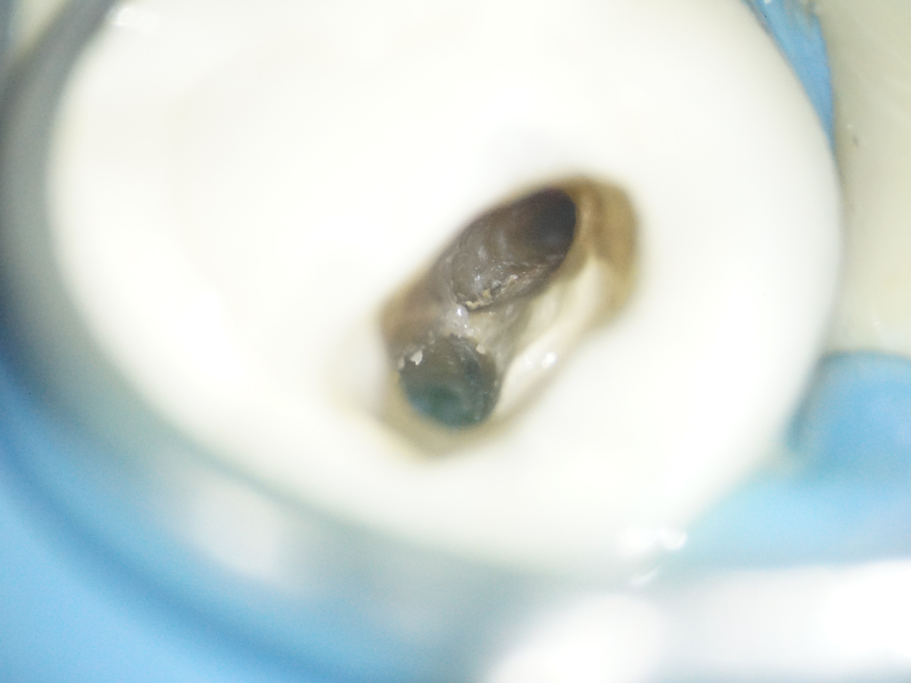 精密根管治療にて抜歯宣告された歯を救った症例　1治療方法06
