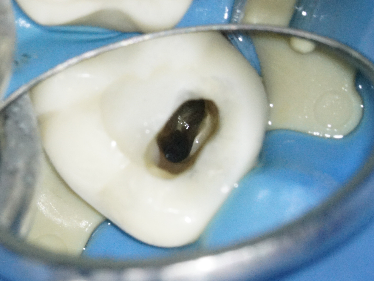 精密根管治療にて抜歯宣告された歯を救った症例　1治療方法07