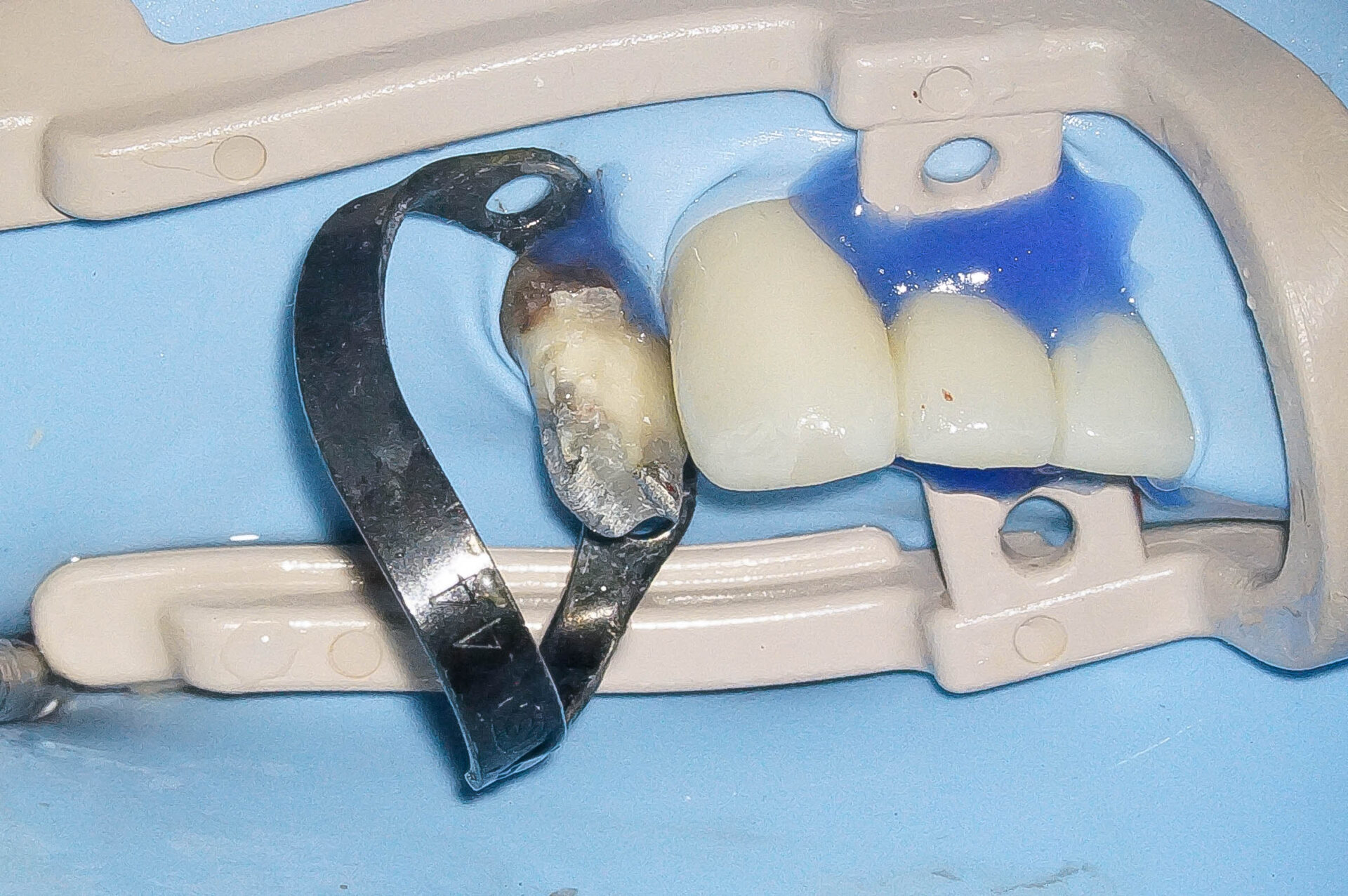 精密根管治療にて抜歯を回避した症例 3治療方法03