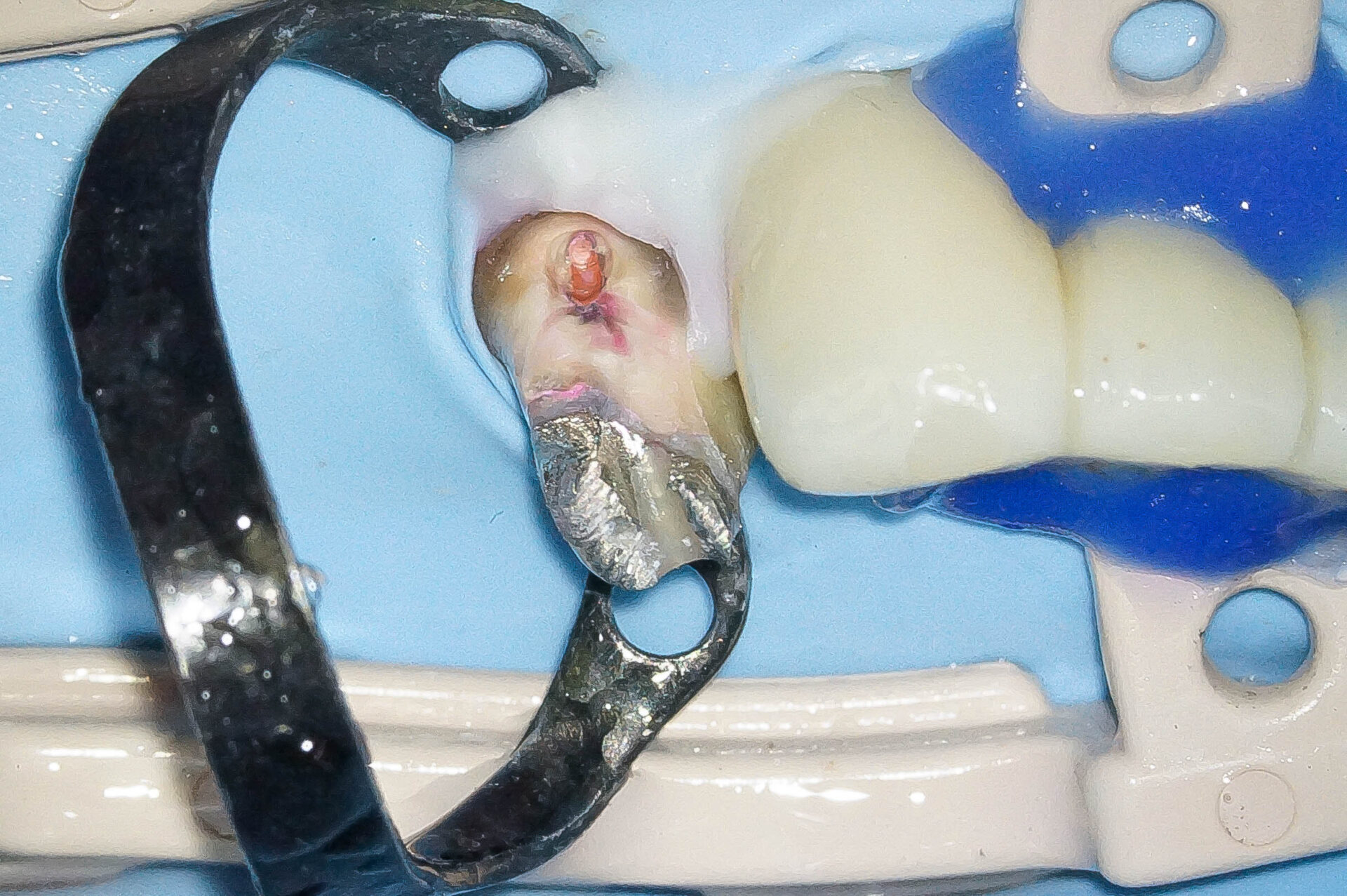 精密根管治療にて抜歯を回避した症例 3治療方法04