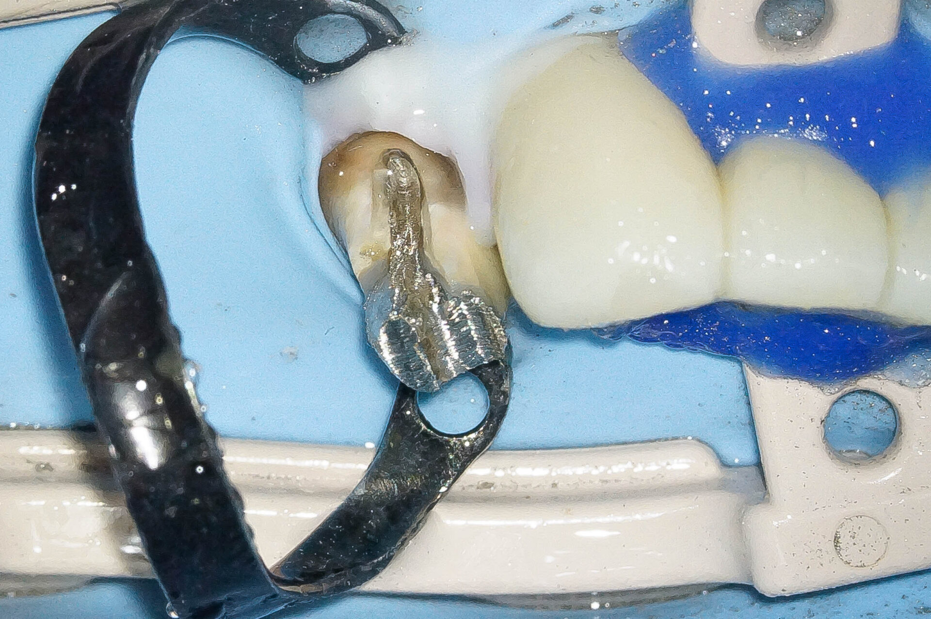 精密根管治療にて抜歯を回避した症例 3治療方法05