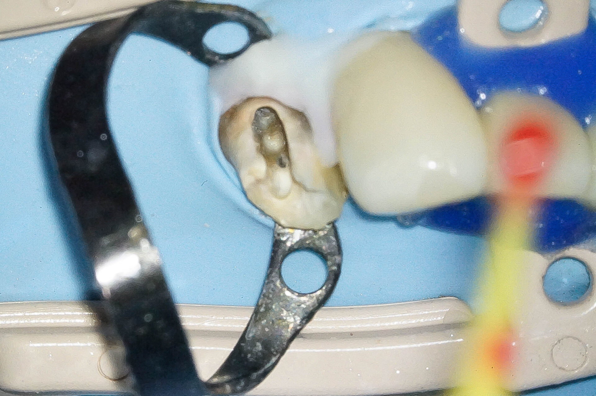 精密根管治療にて抜歯を回避した症例 3治療方法06