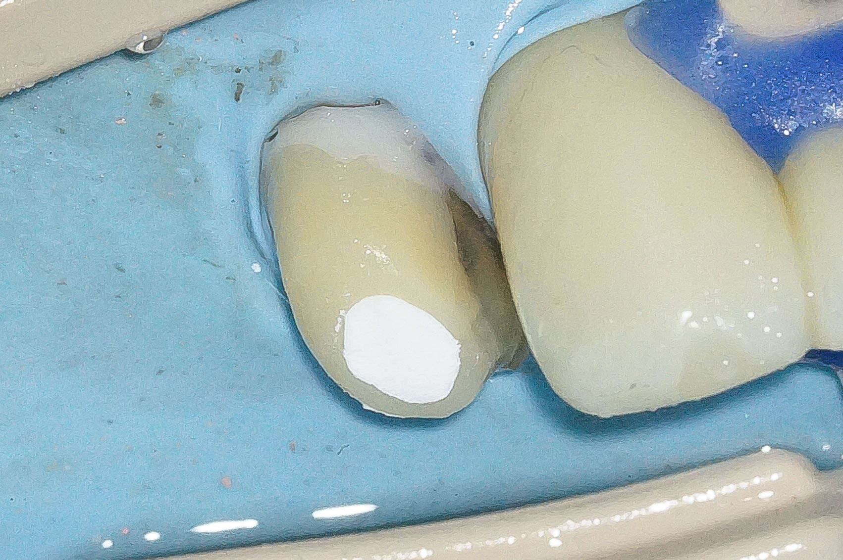 精密根管治療にて抜歯を回避した症例 3治療方法15