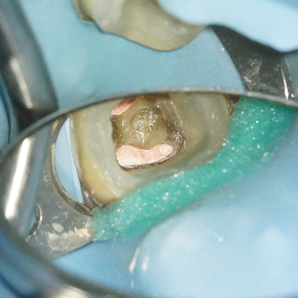 精密根管治療にて抜歯宣告された歯を救った症例　2治療方法12