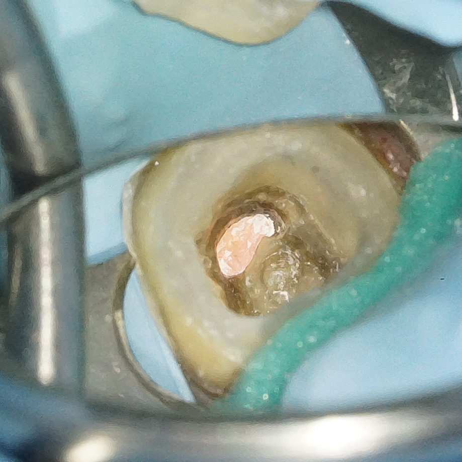精密根管治療にて抜歯宣告された歯を救った症例　2治療方法13
