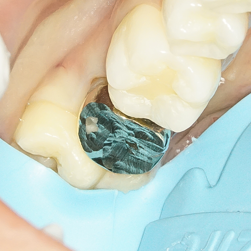 精密根管治療にて抜歯宣告された歯を救った症例　2治療方法04