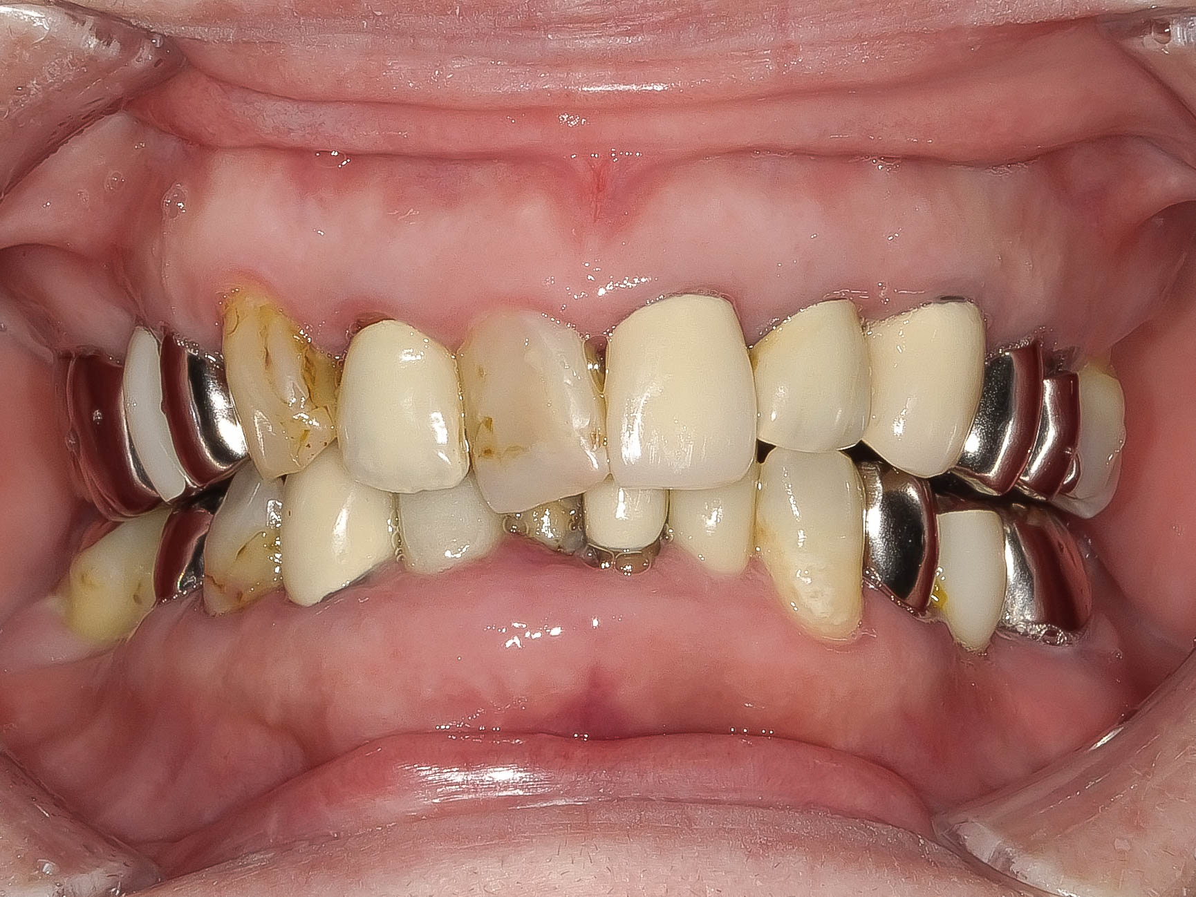 精密根管治療にて抜歯を回避した症例 3治療方法18