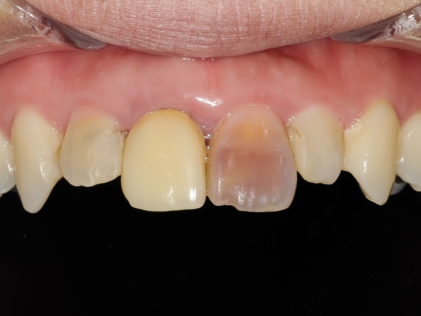 歯の色と形をセラミックで美しくした症例治療方法01