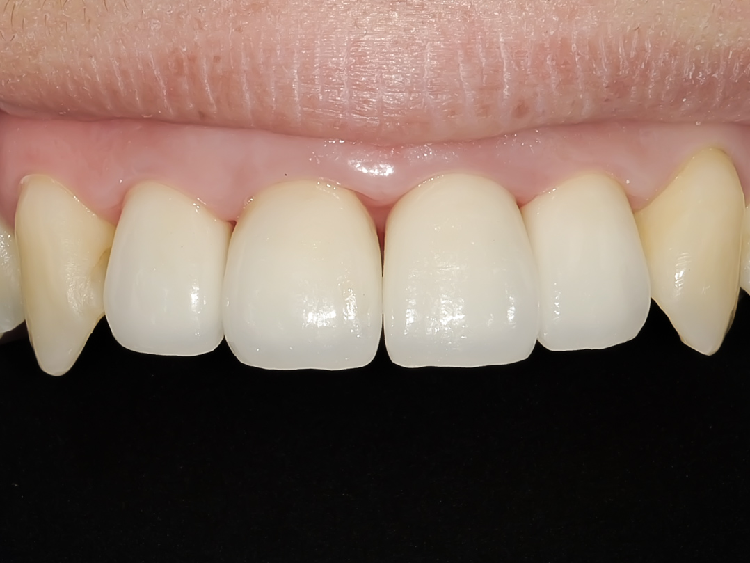 歯の色と形をセラミックで美しくした症例治療方法03