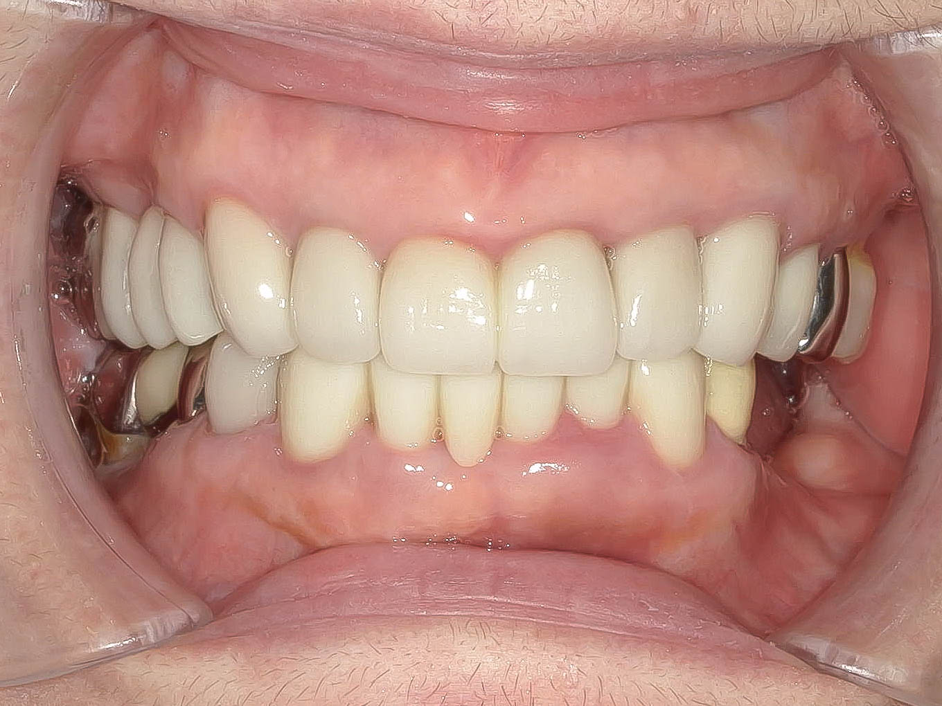 精密根管治療にて抜歯を回避した症例 3治療方法19