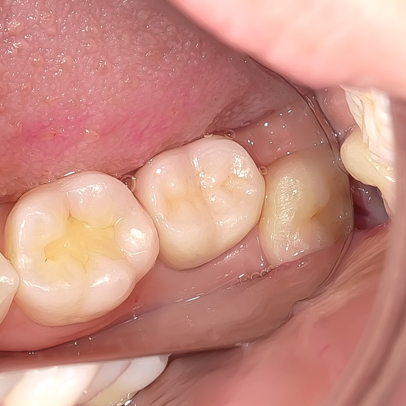 精密根管治療にて抜歯宣告された歯を救った症例　2治療方法14