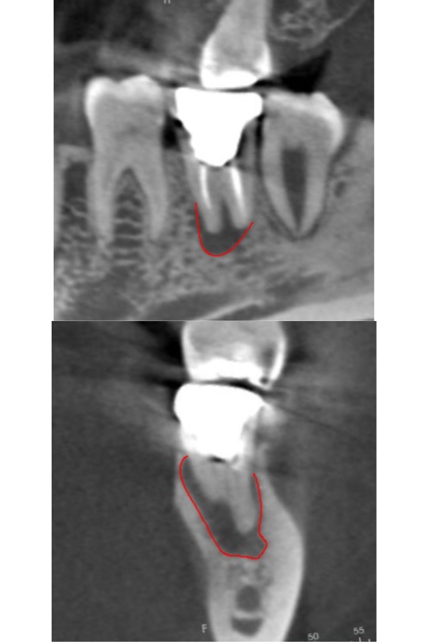 精密根管治療にて抜歯宣告された歯を救った症例　2治療方法03