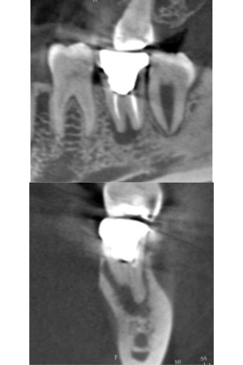 精密根管治療にて抜歯宣告された歯を救った症例　2BEFORE
