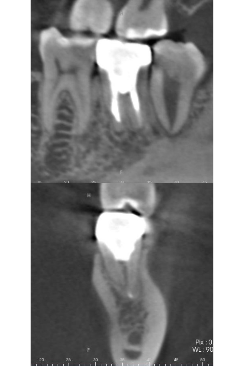 精密根管治療にて抜歯宣告された歯を救った症例　2