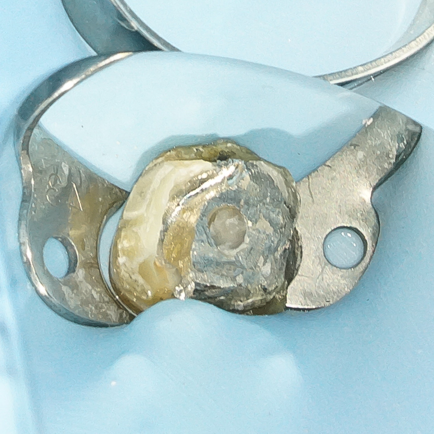 精密根管治療にて抜歯宣告された歯を救った症例　2治療方法05