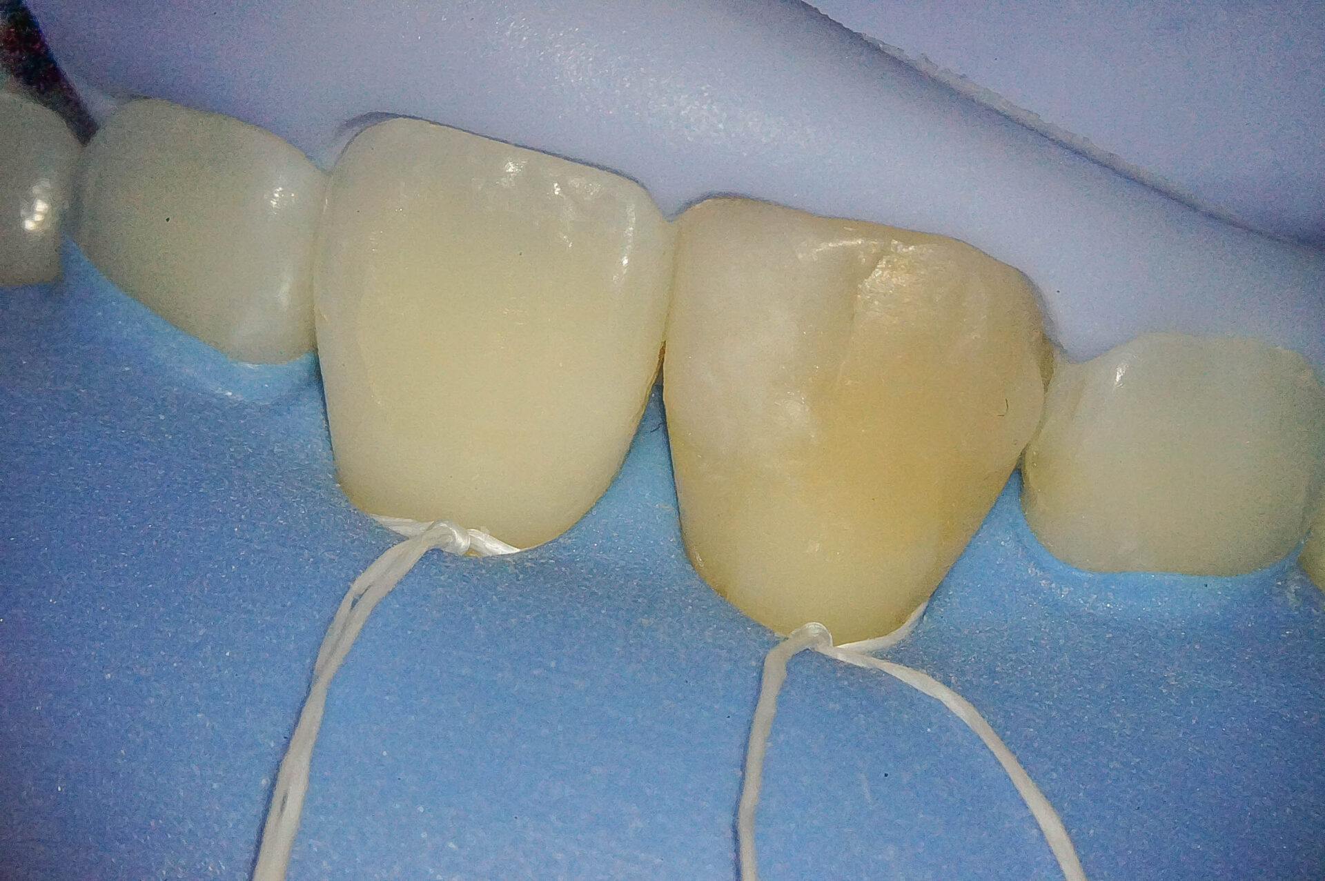 前歯が変色している状態に対してダイレクトボンディングにて対応した症例治療方法04
