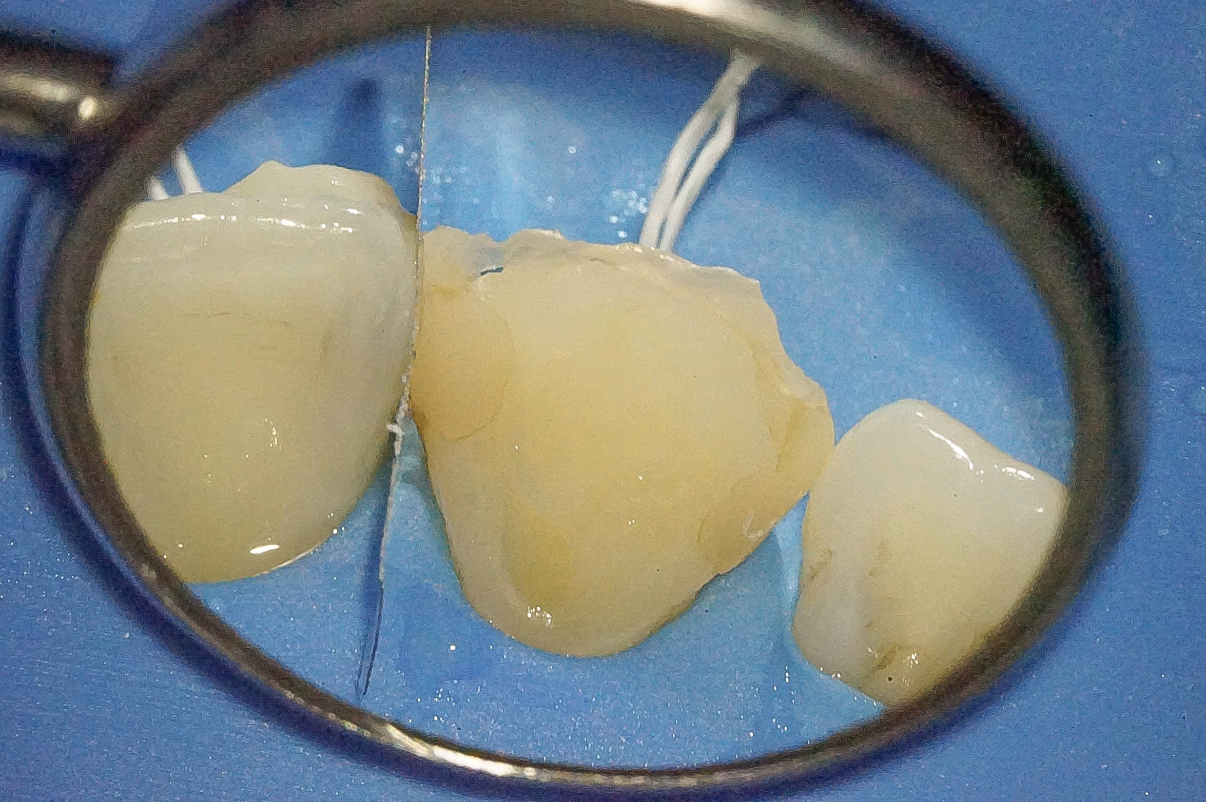 前歯が変色している状態に対してダイレクトボンディングにて対応した症例治療方法05