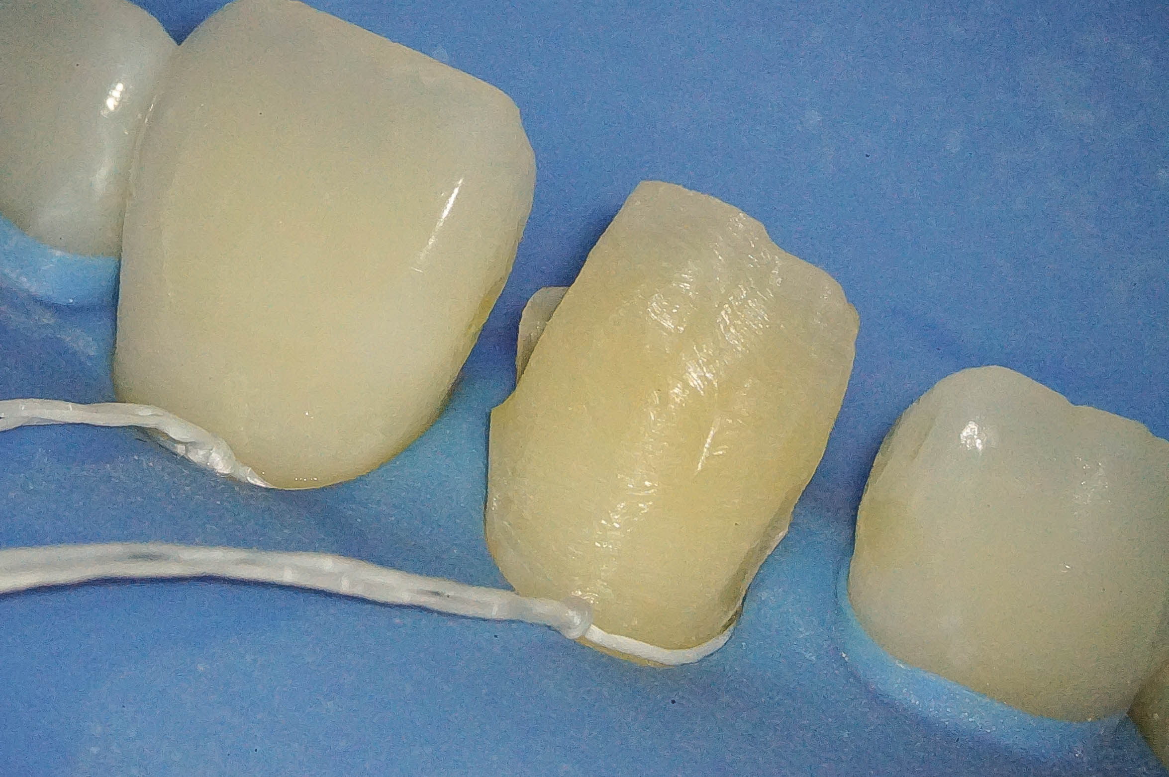 前歯が変色している状態に対してダイレクトボンディングにて対応した症例治療方法08