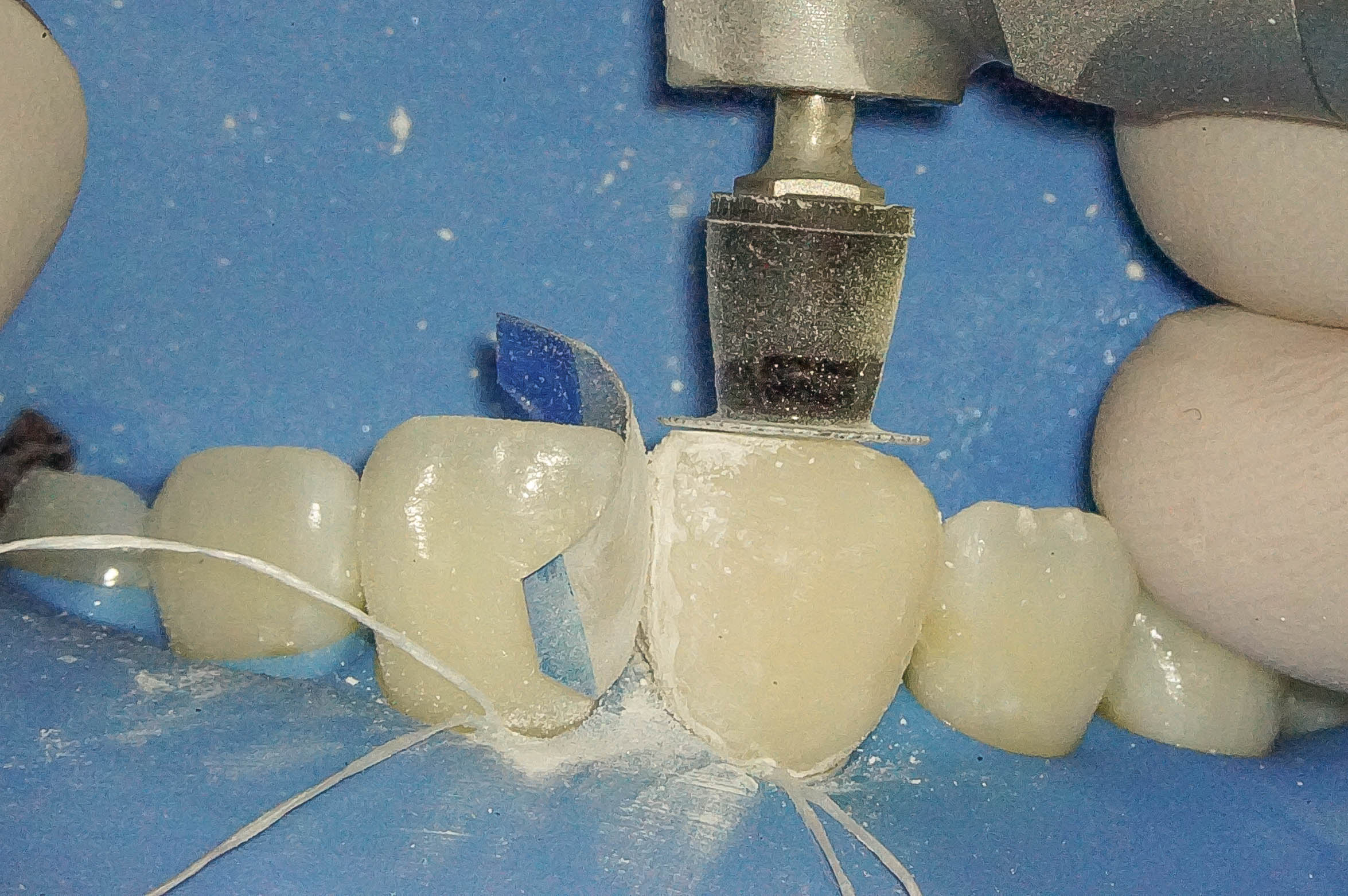 前歯が変色している状態に対してダイレクトボンディングにて対応した症例治療方法10